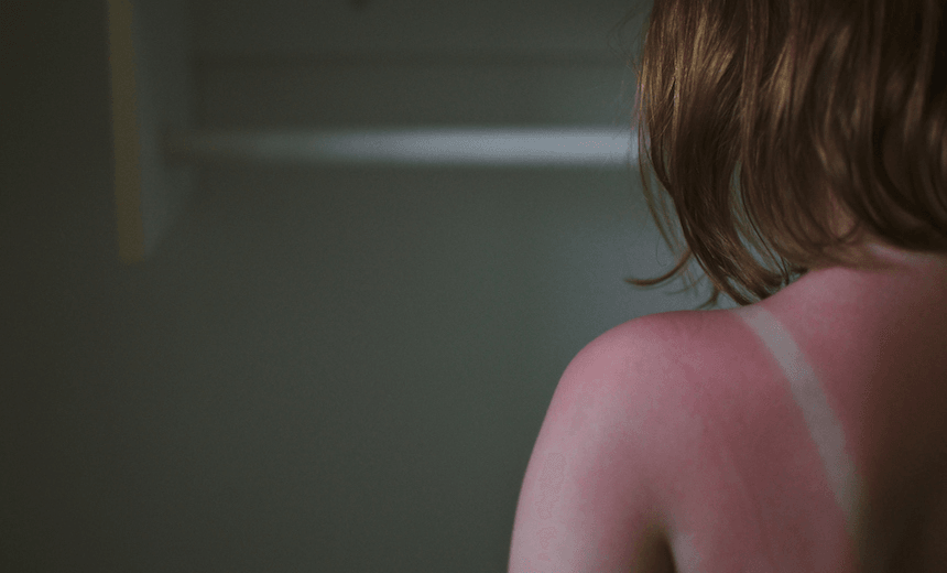 Back view of woman against sun burns on her back. 
