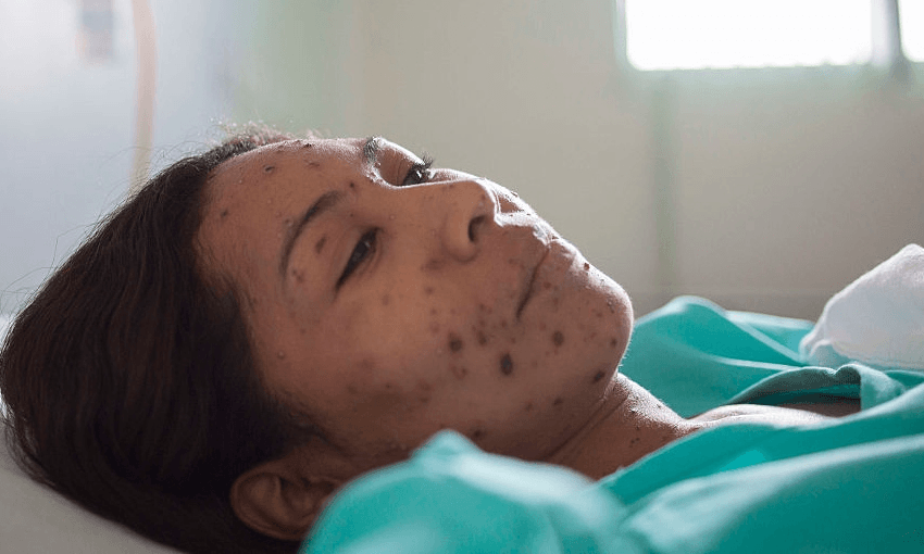 Measles, a highly contagious infection caused by the measles virus is an airborne disease which spreads easily through the coughs and sneezes of those infected – red rash which usually starts on the face and then spreads to the rest of the body is the typical symptom. (Photo by Ricardo Funari/Brazil Photos/LightRocket via Getty Images) 
