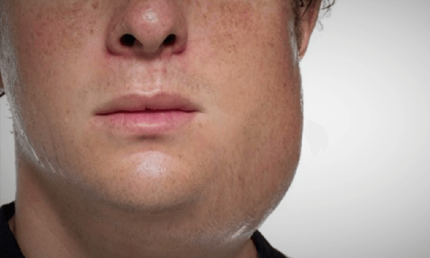 a man with mumps. one side of his face is very swollen like he one big smooth jowl