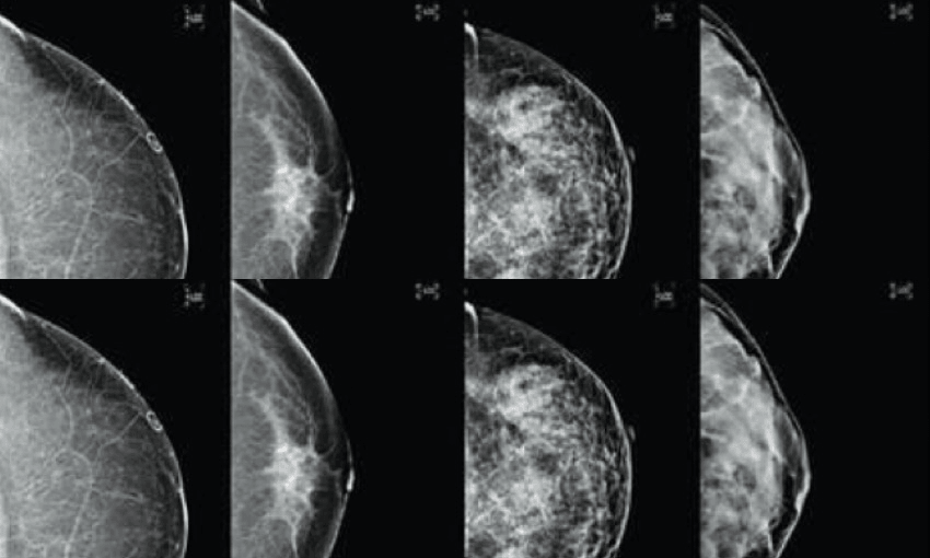 We need to talk about breast density and cancer