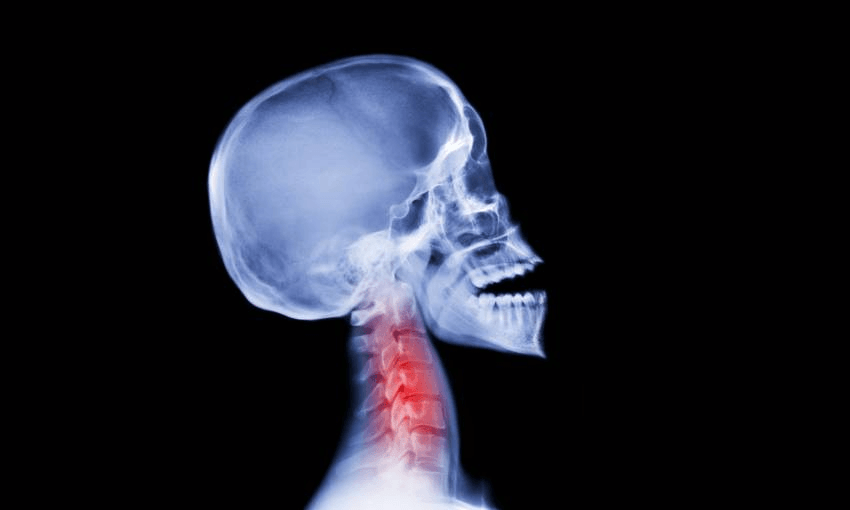 a side profile x ray of a human skull and neck, a red cloud over the cervical vertebrae