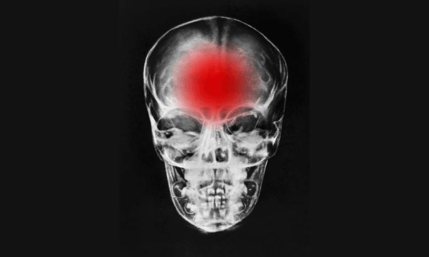 an x ray of a human skull with a red cloud over the frontal bone