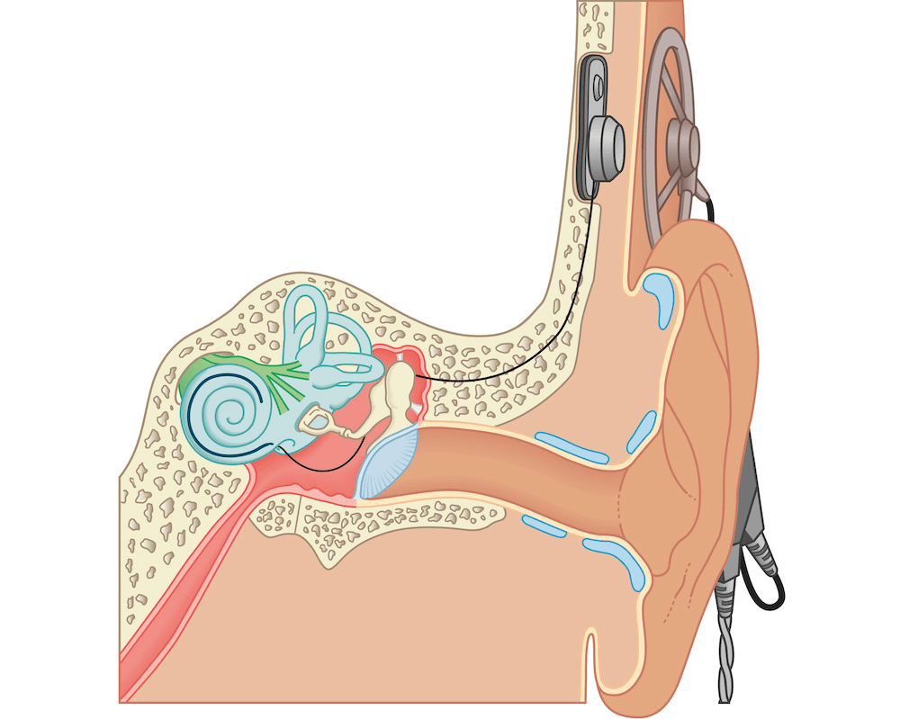 Diagram of a cochlear implant