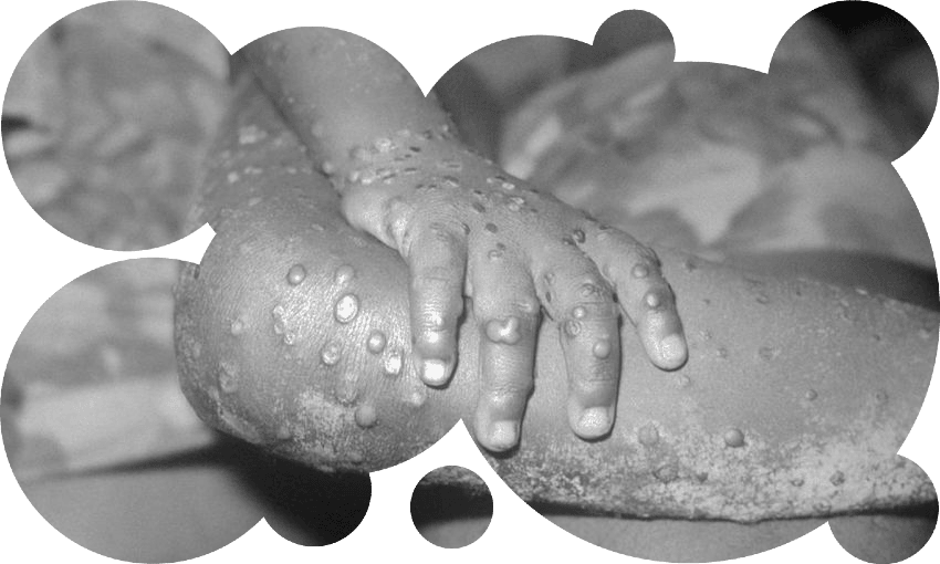  Close-up of monkeypox lesions on the arm and leg of young girl, Liberia (Photo: CDC/Public Domain) 
