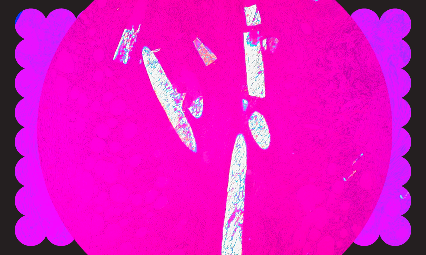 Radiographic Marker in Lumpectomy Specimen (Image: Ed Uthman, CC BY 2.0 via Wikimedia Commons 
