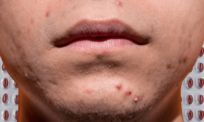When’s the last time you saw severe acne on the street? (Photos: Getty. Composite image: The Spinoff) 
