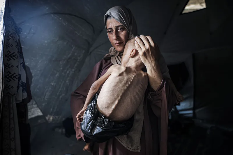 Malnourished toddler in Gaza fights for life amid ongoing Israeli attacks