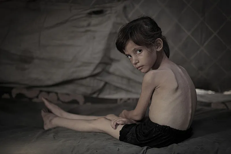 Health of malnourished Gazan girl continues to deteriorate