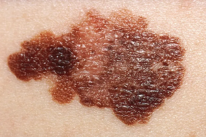 Close-up of a mole or lesion on human skin with irregular borders and varying shades of brown and black, suggesting an abnormal or possibly melanoma growth.