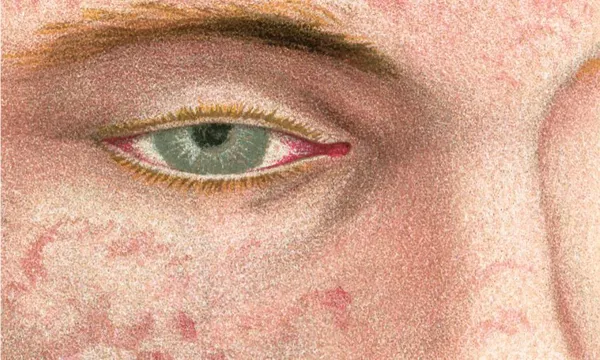What's it actually like to have the measles?