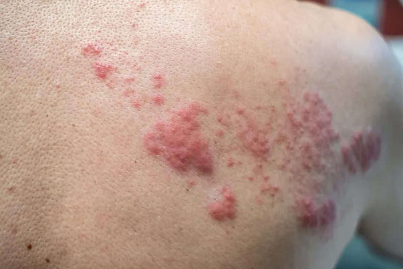 Shingles (Disease), Herpes zoster, varicella-zoster virus. skin rash and blisters