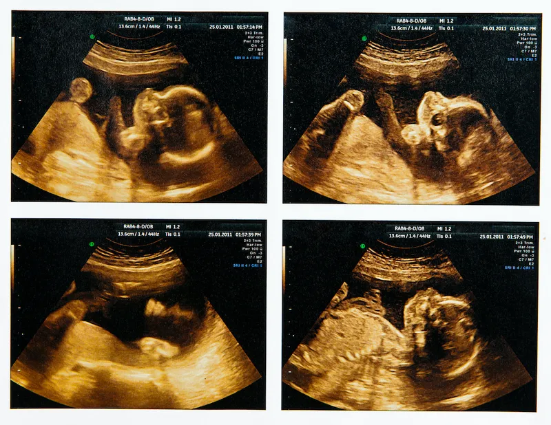 Compilation of four fetus ultrasounds