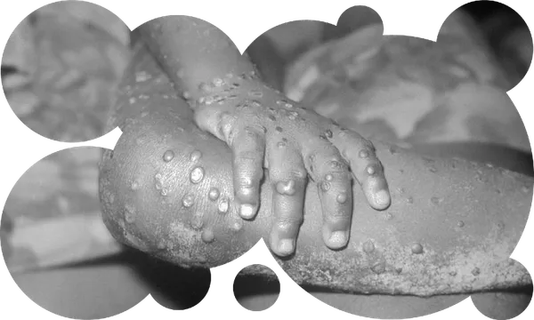 Monkeypox
