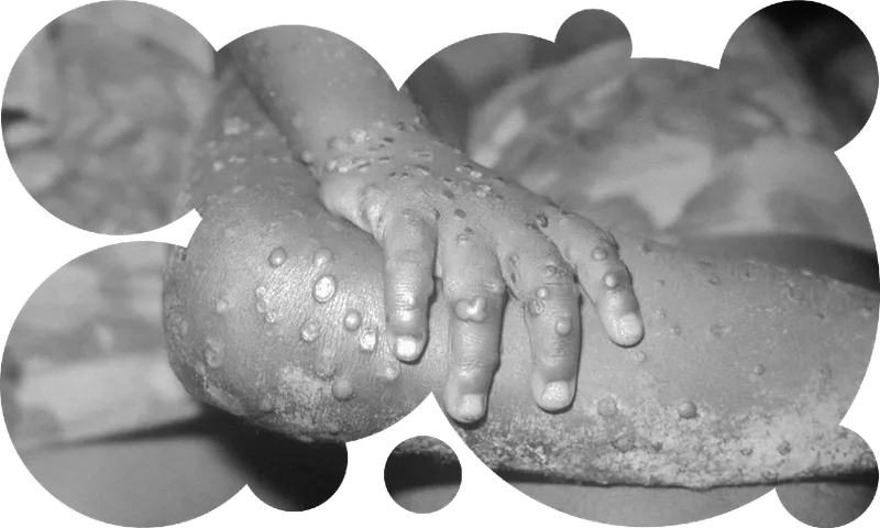 Monkeypox