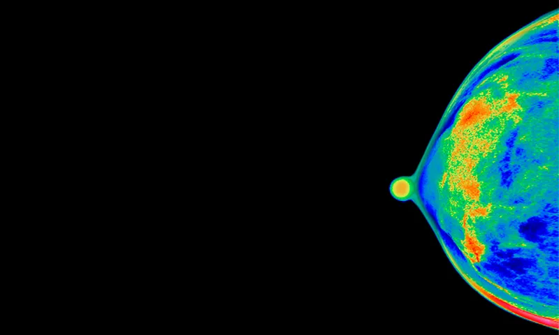 Mammogram of 40 year old woman’s breast