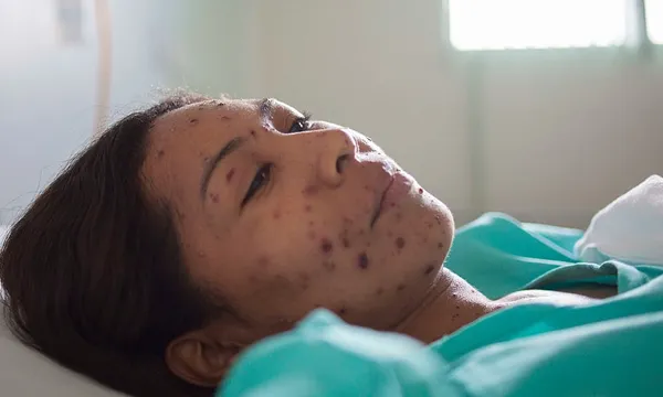 brazil woman with measles getty