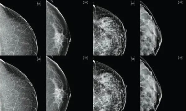 breast