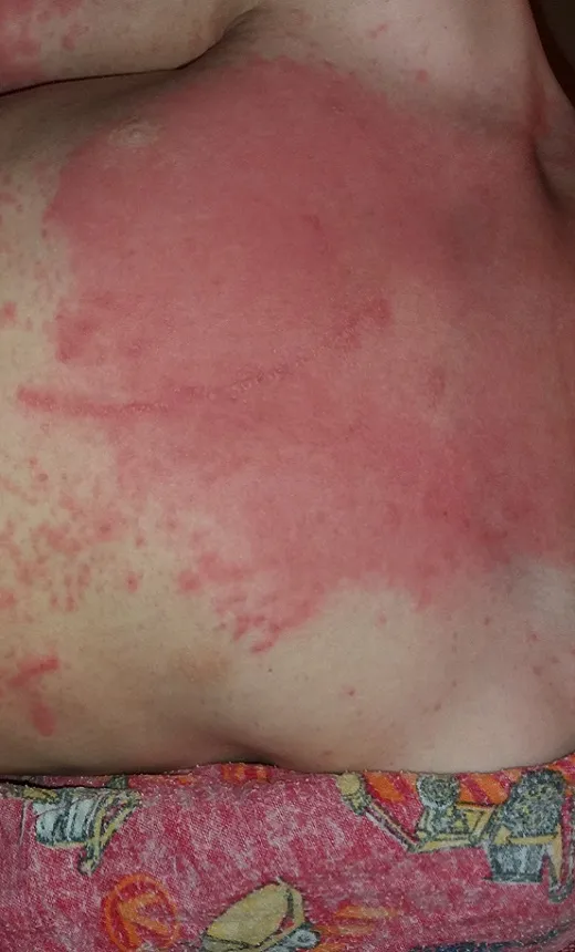 rash