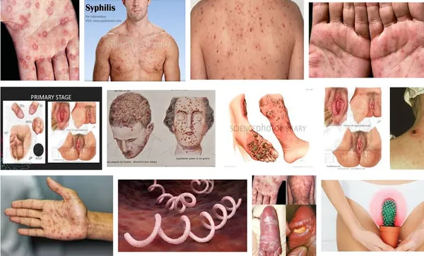syphilis
