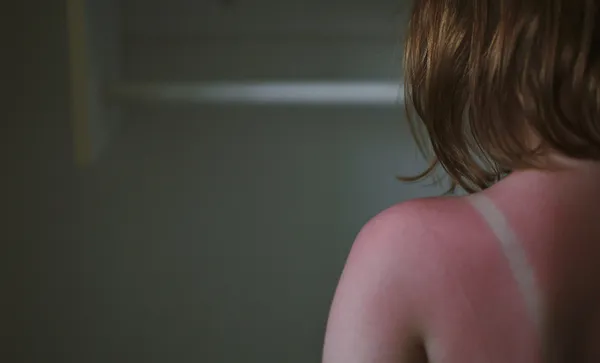 Sun burns