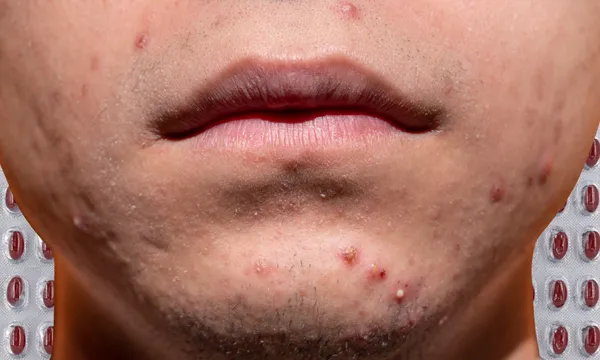 a close up of a young man's mouth and jaw, with dark red pimples spotted all over. in the background, pill packets with brown pills inside