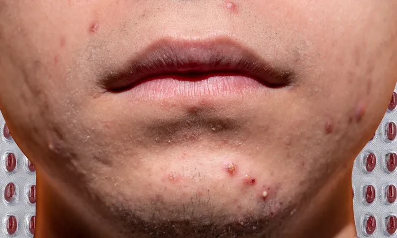 a close up of a young man's mouth and jaw, with dark red pimples spotted all over. in the background, pill packets with brown pills inside