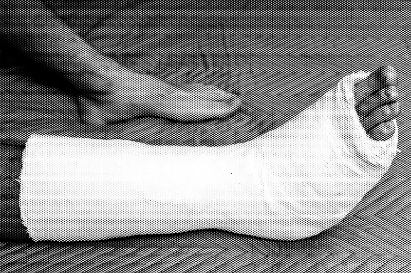A broken leg